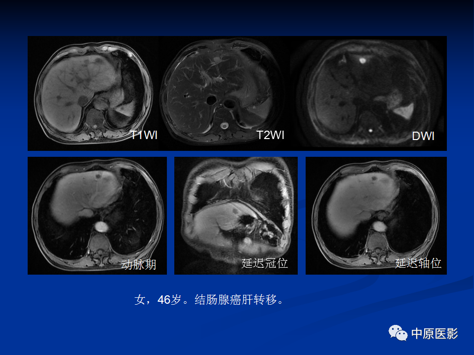 【病例】肝脏胆管细胞癌1例MR影像-19