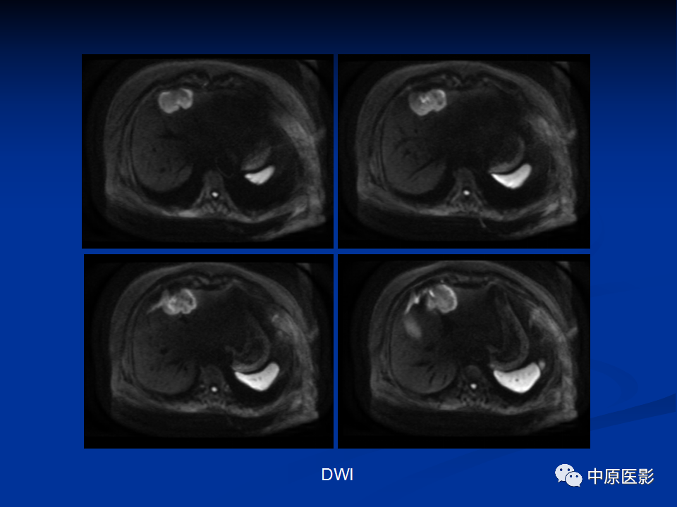 【病例】肝脏胆管细胞癌1例MR影像-6