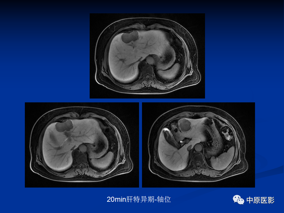 【病例】肝脏胆管细胞癌1例MR影像-10