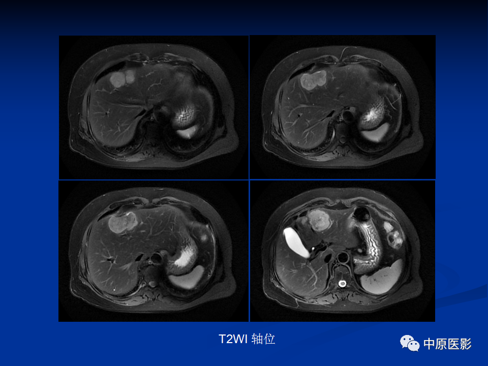 【病例】肝脏胆管细胞癌1例MR影像-5