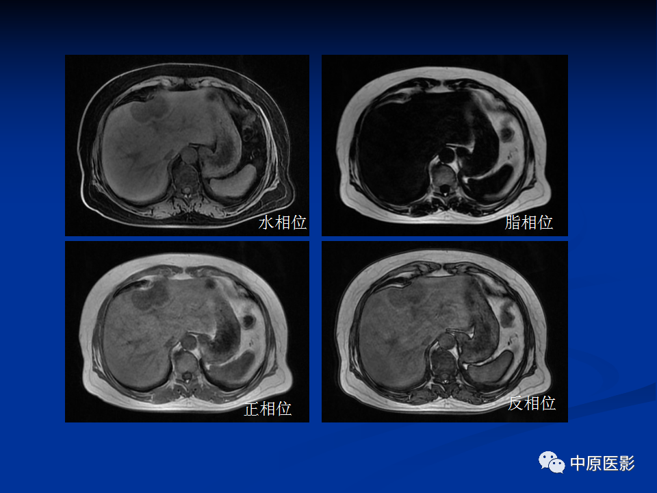【病例】肝脏胆管细胞癌1例MR影像-3