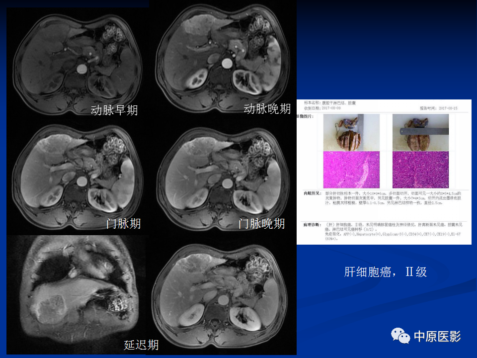 【病例】肝脏胆管细胞癌1例MR影像-22