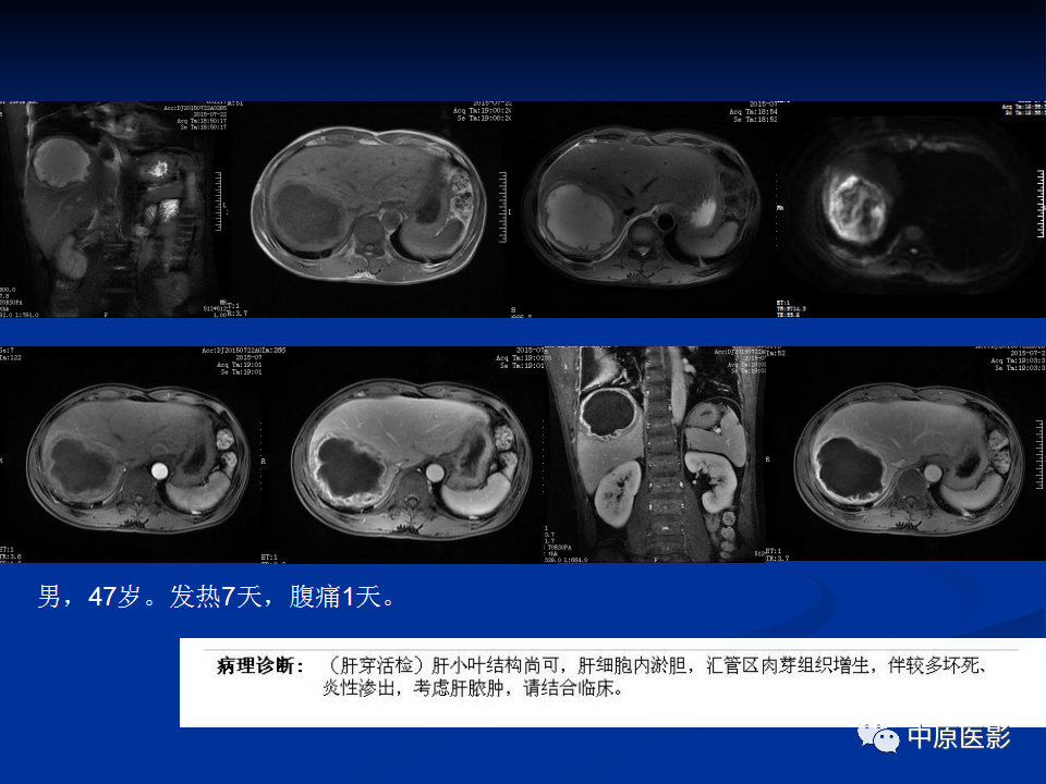 【病例】肝脏胆管细胞癌1例MR影像-24