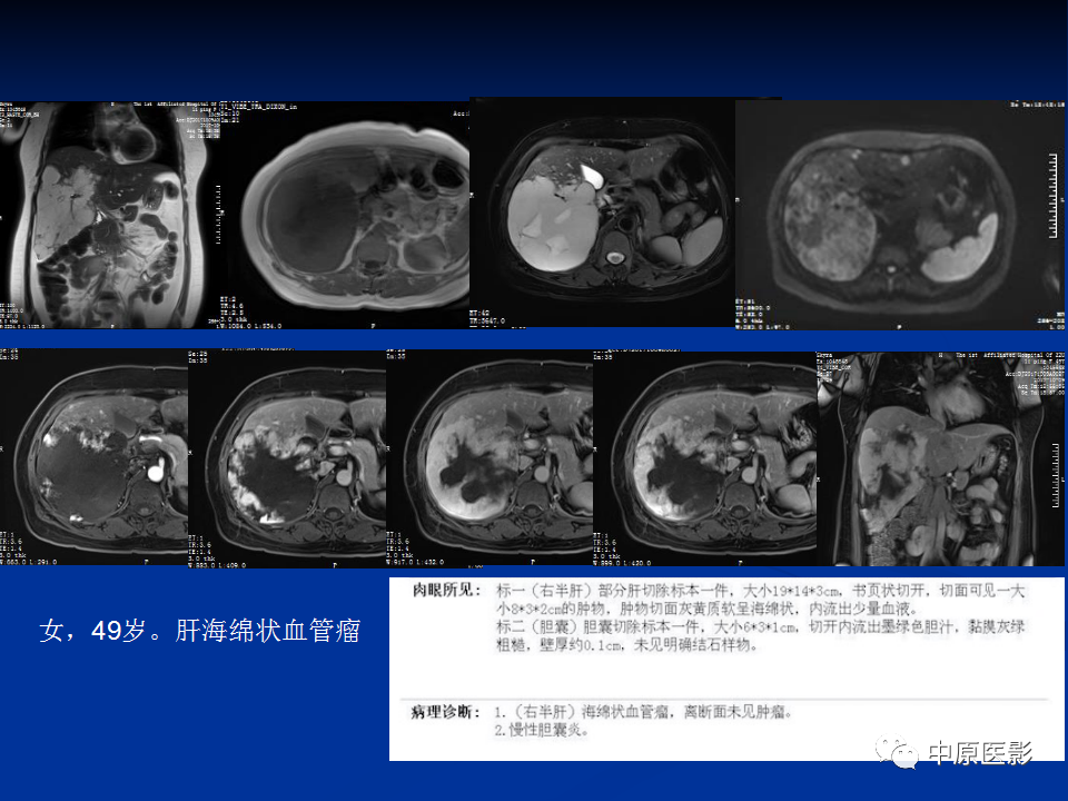 【病例】肝脏胆管细胞癌1例MR影像-26