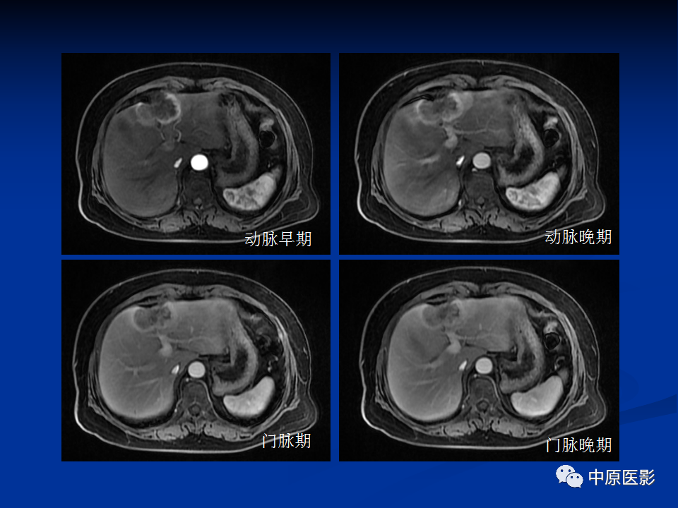 【病例】肝脏胆管细胞癌1例MR影像-7