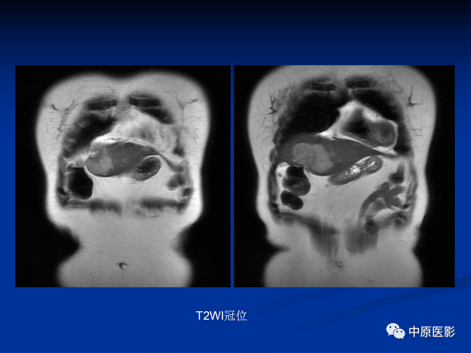【病例】肝脏胆管细胞癌1例MR影像-4