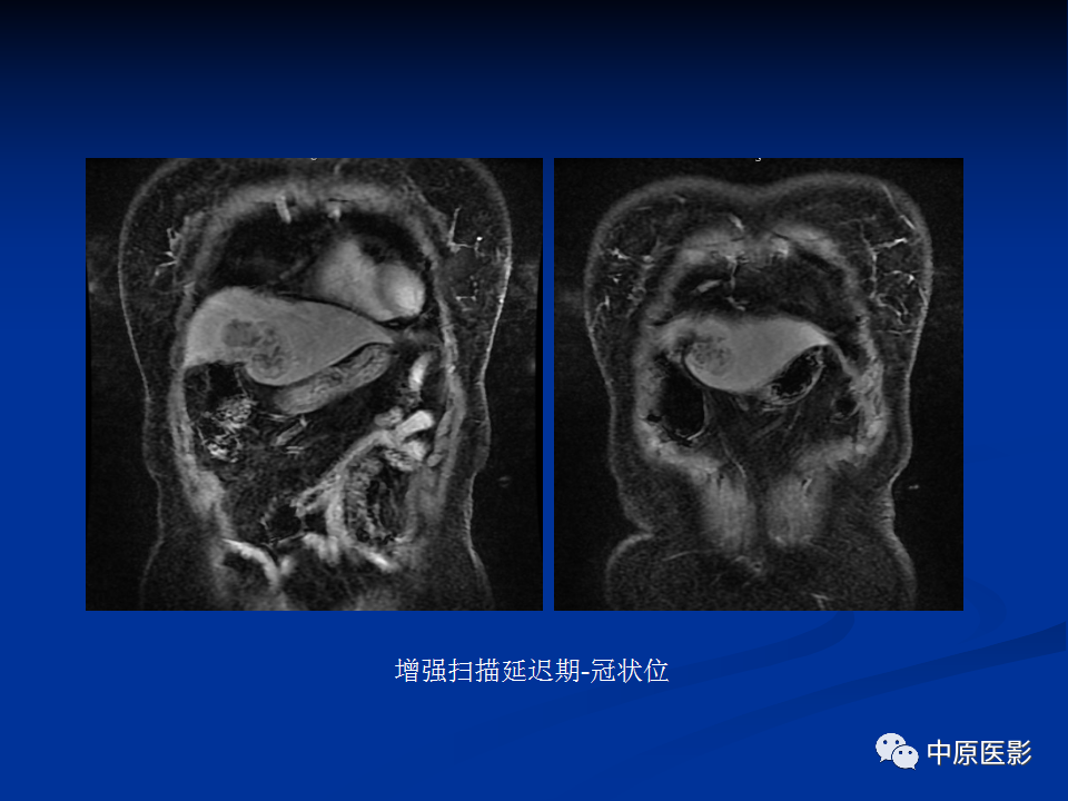 【病例】肝脏胆管细胞癌1例MR影像-8