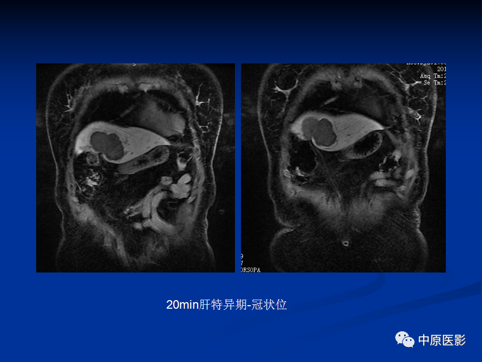【病例】肝脏胆管细胞癌1例MR影像-11