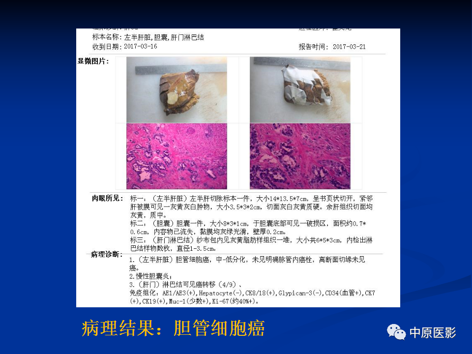 【病例】肝脏胆管细胞癌1例MR影像-14