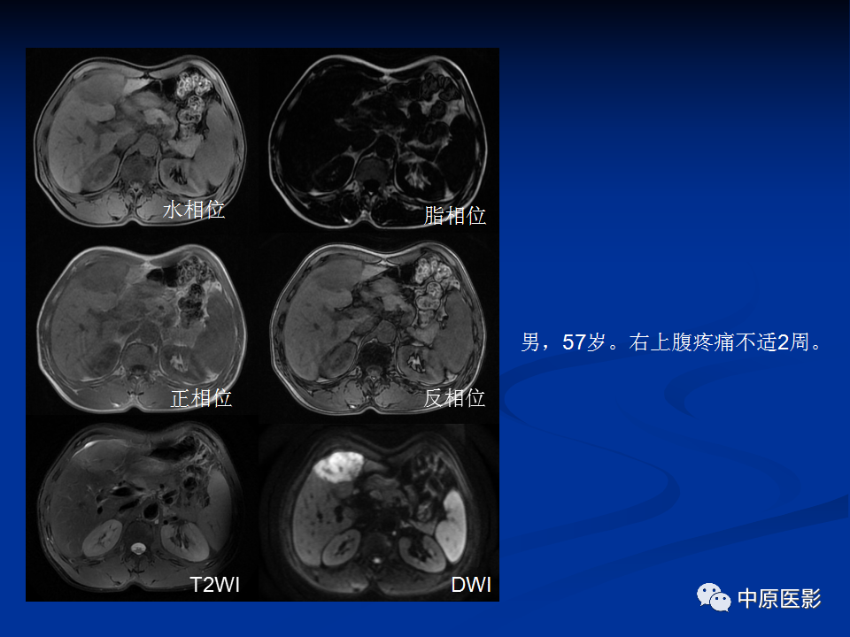 【病例】肝脏胆管细胞癌1例MR影像-21