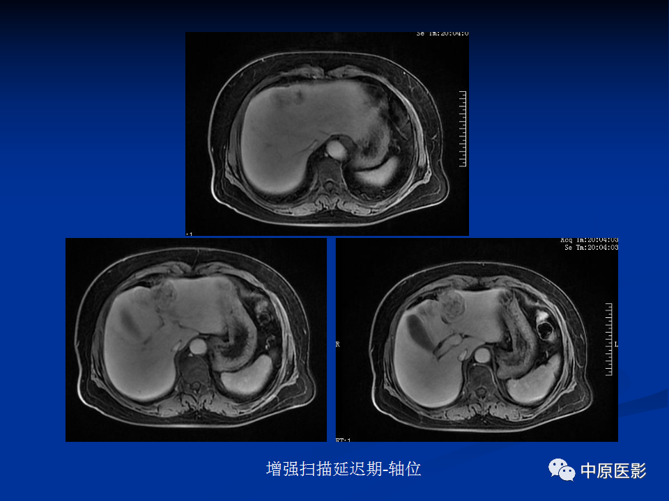 【病例】肝脏胆管细胞癌1例MR影像-9