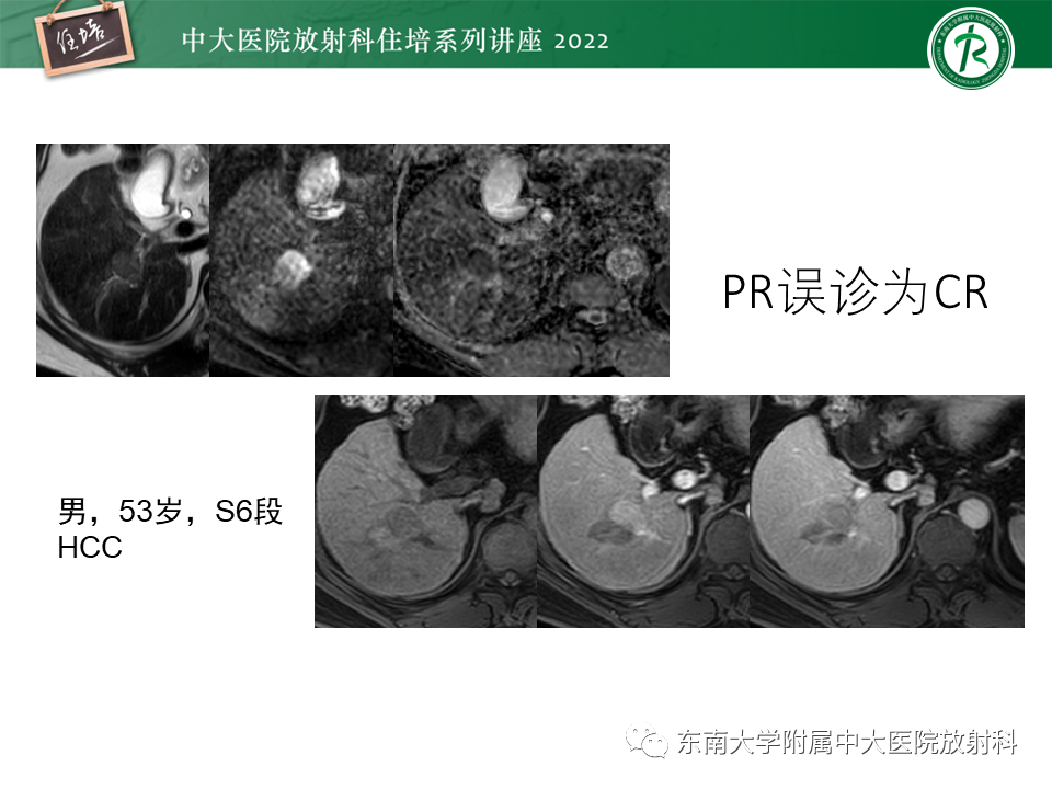【PPT】肝癌介入治疗后的磁共振评估-24