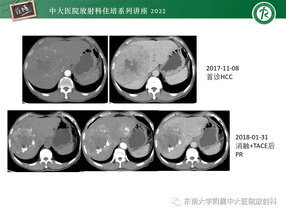 【PPT】肝癌介入治疗后的磁共振评估-40
