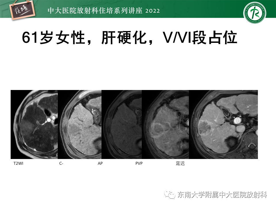 【PPT】肝癌介入治疗后的磁共振评估-18