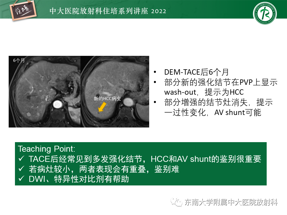 【PPT】肝癌介入治疗后的磁共振评估-32
