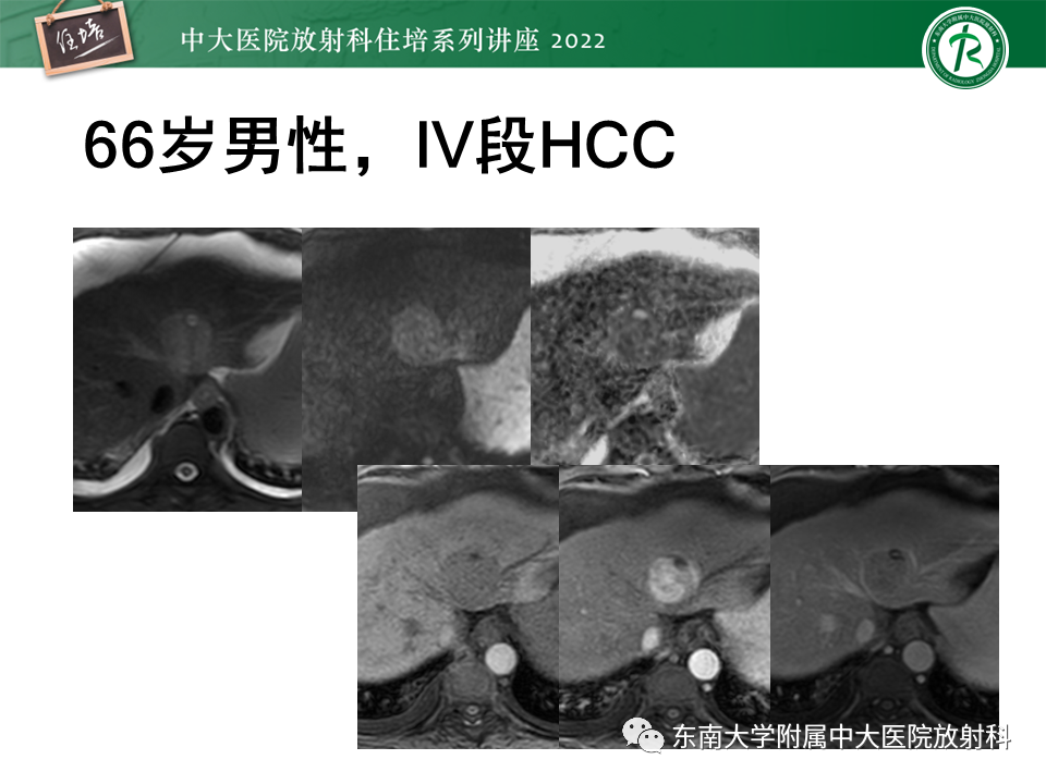 【PPT】肝癌介入治疗后的磁共振评估-21