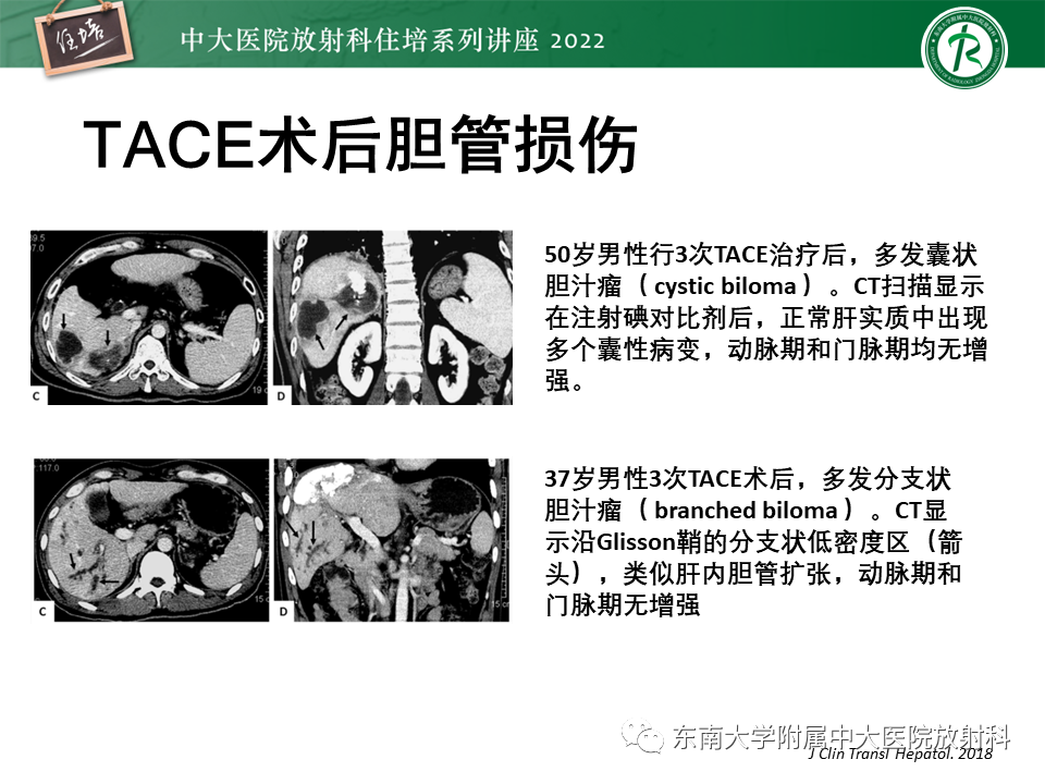 【PPT】肝癌介入治疗后的磁共振评估-45