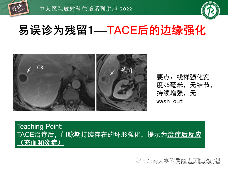 【PPT】肝癌介入治疗后的磁共振评估-10