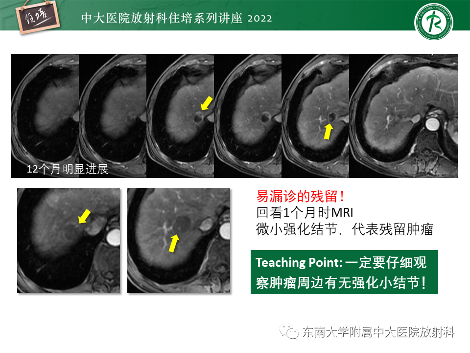【PPT】肝癌介入治疗后的磁共振评估-17