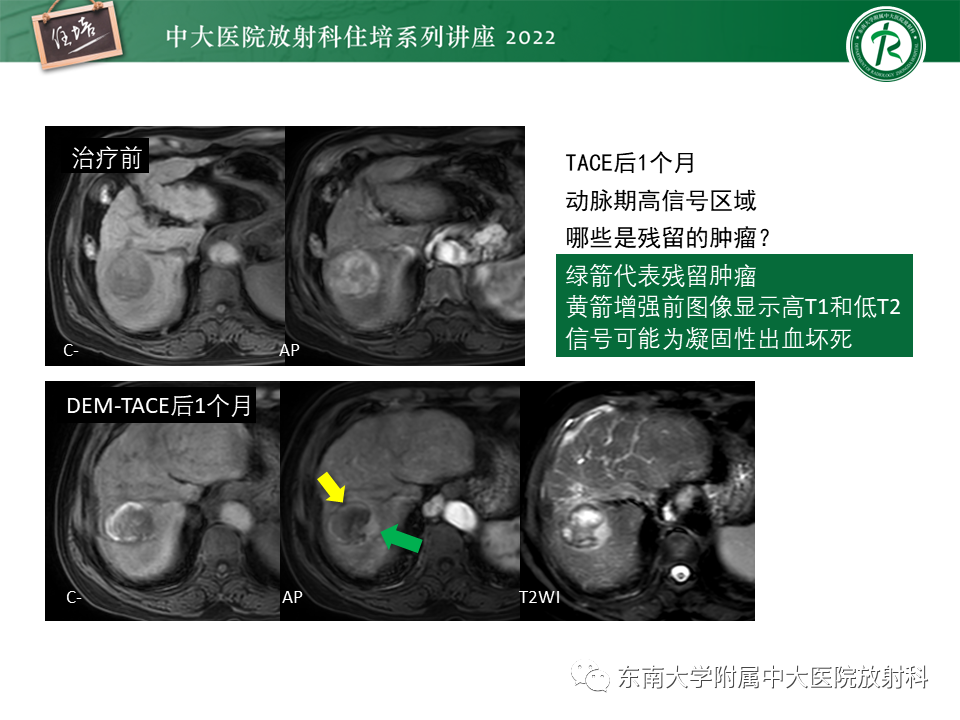 【PPT】肝癌介入治疗后的磁共振评估-11