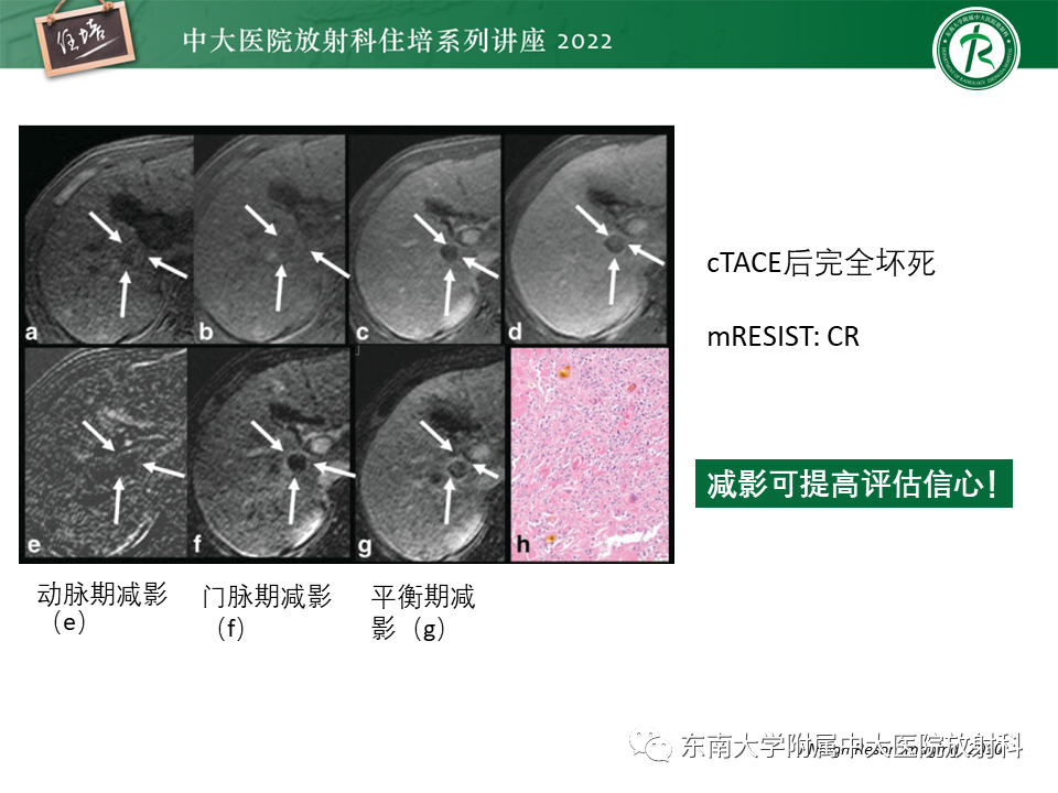 【PPT】肝癌介入治疗后的磁共振评估-13
