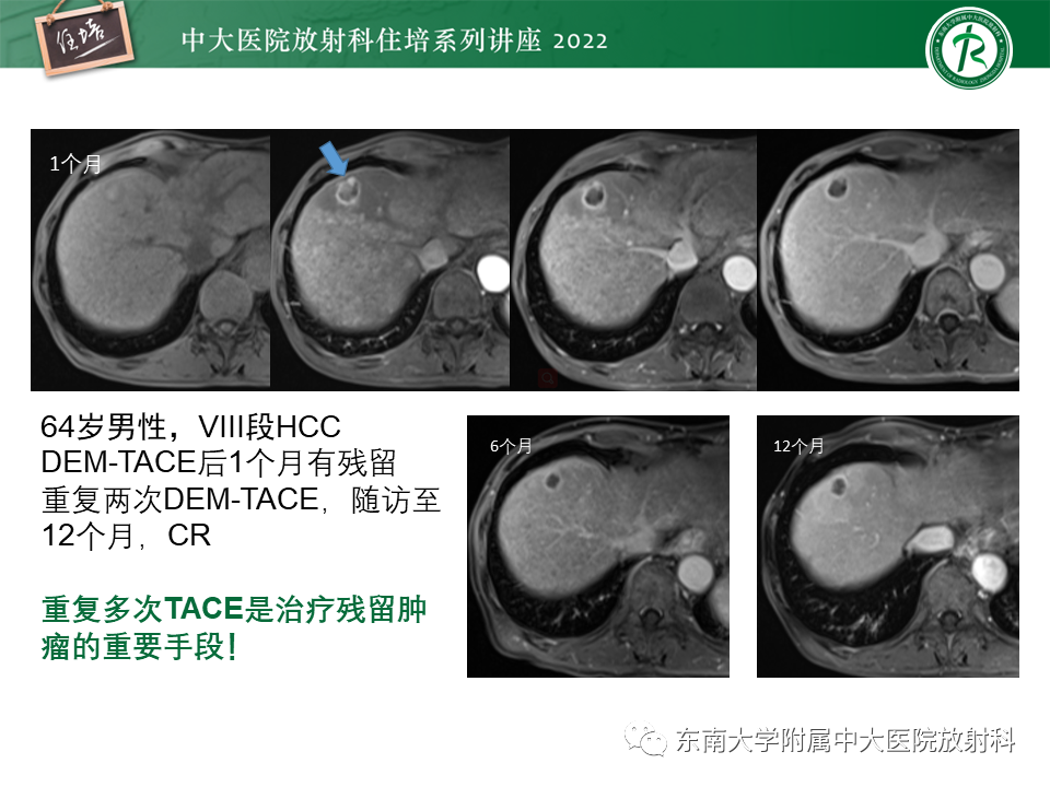 【PPT】肝癌介入治疗后的磁共振评估-27