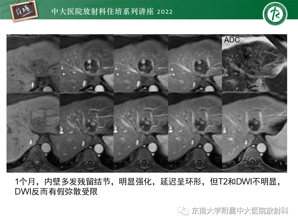 【PPT】肝癌介入治疗后的磁共振评估-22