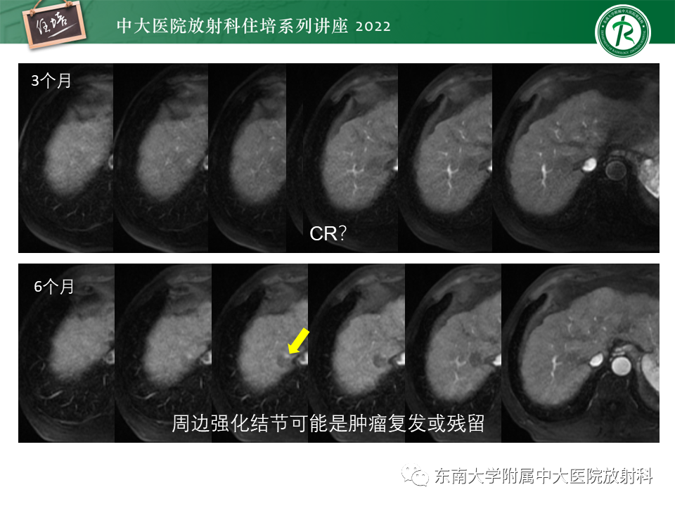 【PPT】肝癌介入治疗后的磁共振评估-16