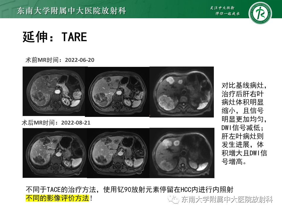 【PPT】肝癌介入治疗后的磁共振评估-48