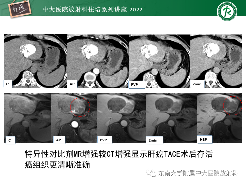 【PPT】肝癌介入治疗后的磁共振评估-37