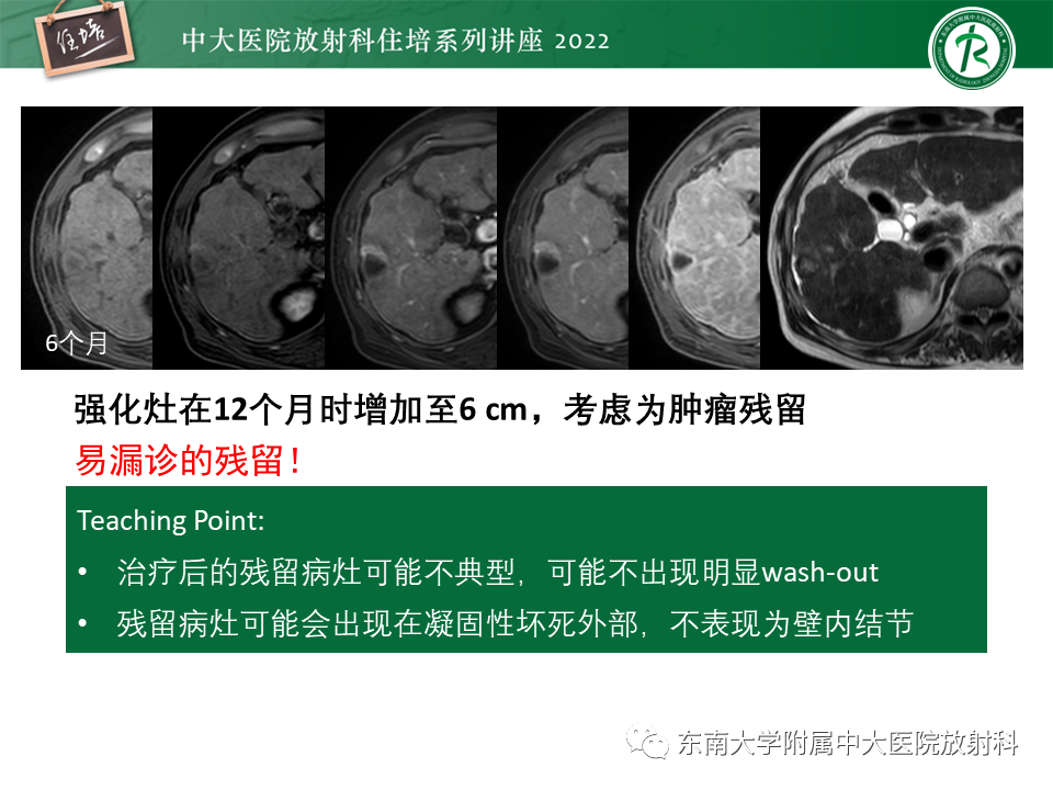【PPT】肝癌介入治疗后的磁共振评估-20