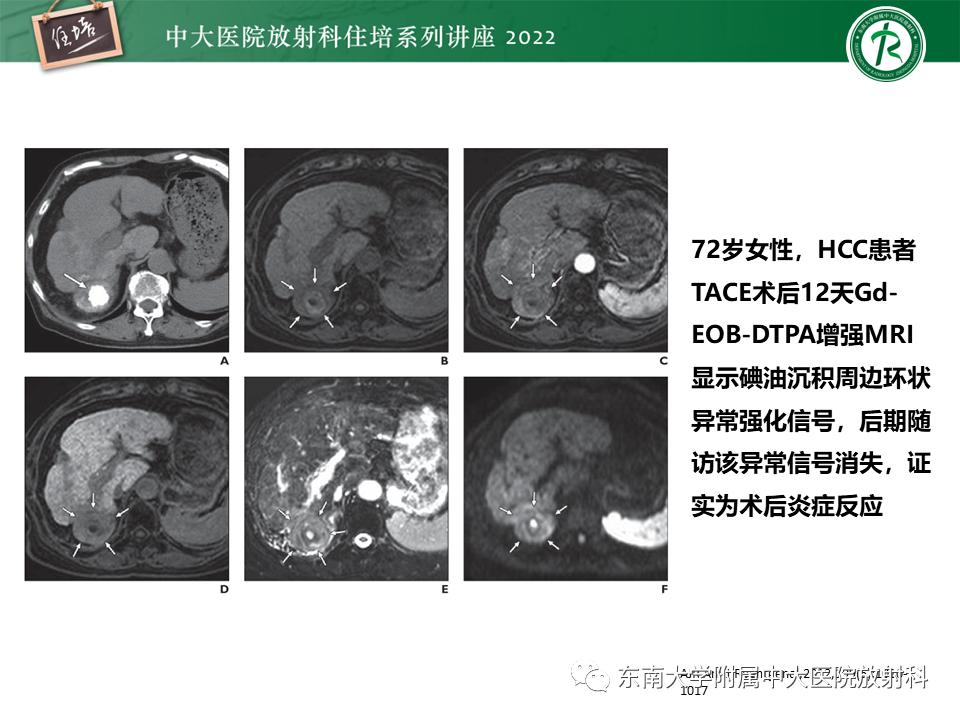 【PPT】肝癌介入治疗后的磁共振评估-38