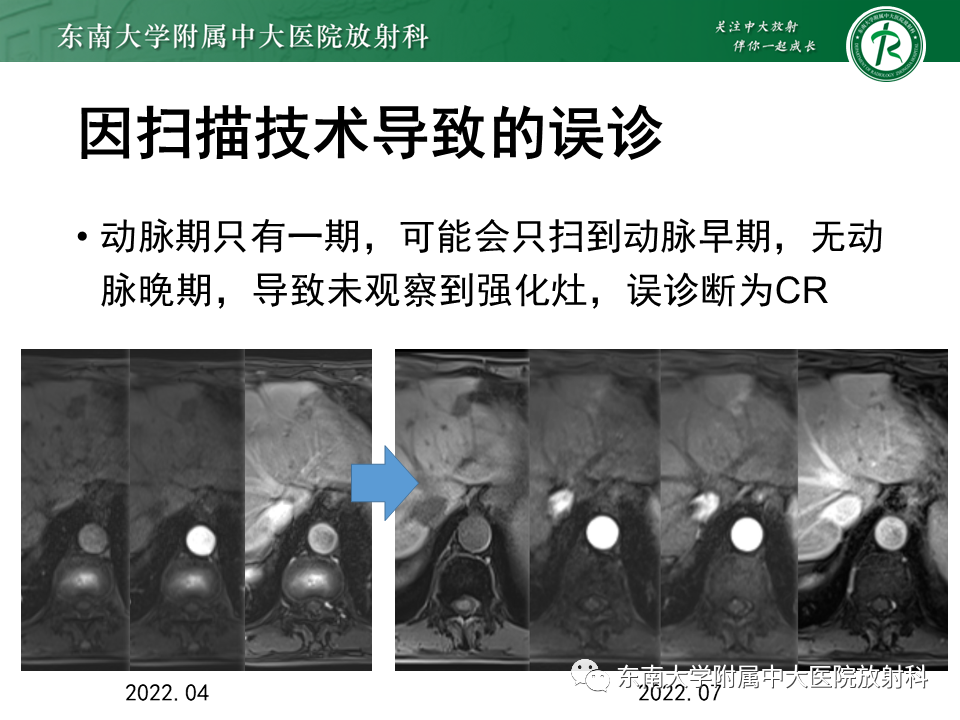 【PPT】肝癌介入治疗后的磁共振评估-28