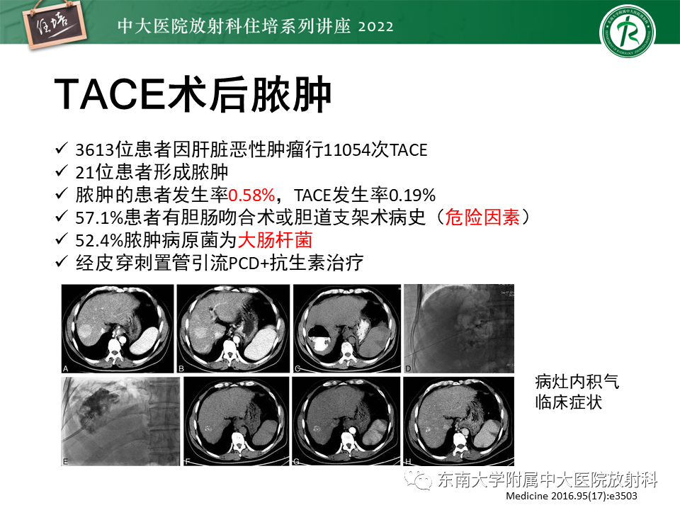 【PPT】肝癌介入治疗后的磁共振评估-47