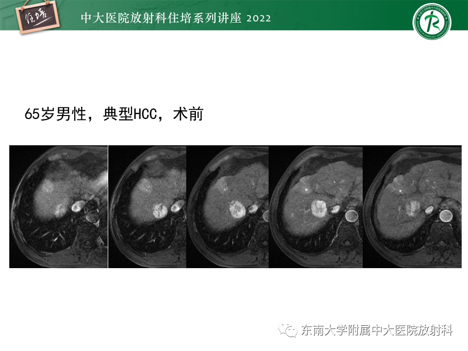 【PPT】肝癌介入治疗后的磁共振评估-14