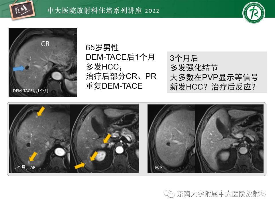 【PPT】肝癌介入治疗后的磁共振评估-31