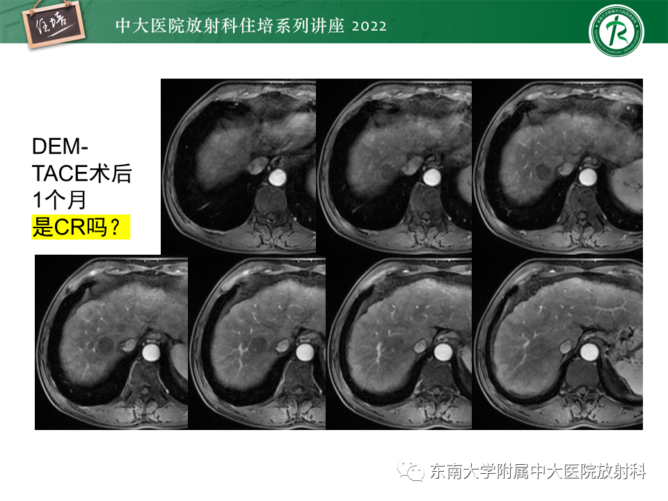 【PPT】肝癌介入治疗后的磁共振评估-15