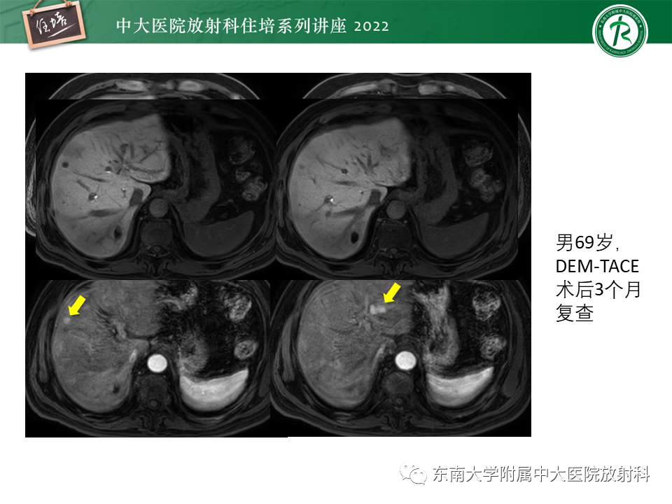 【PPT】肝癌介入治疗后的磁共振评估-36