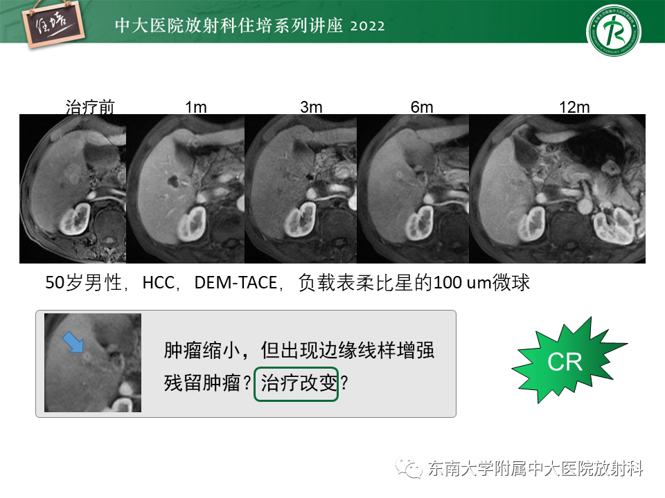【PPT】肝癌介入治疗后的磁共振评估-9