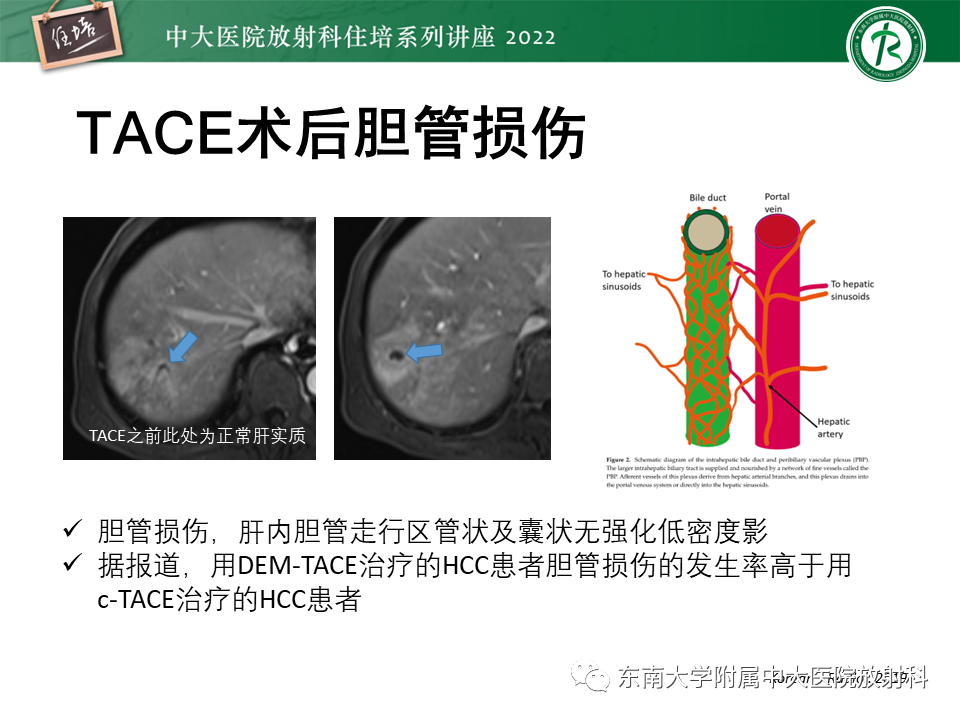 【PPT】肝癌介入治疗后的磁共振评估-44