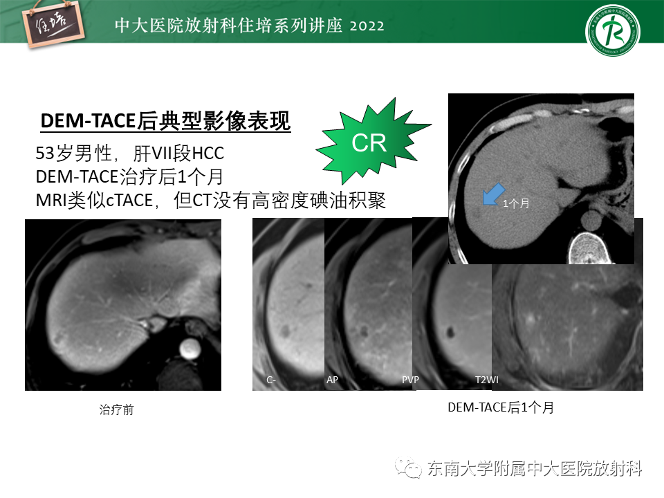 【PPT】肝癌介入治疗后的磁共振评估-8
