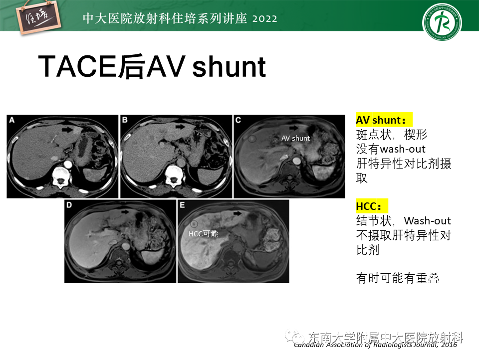 【PPT】肝癌介入治疗后的磁共振评估-33