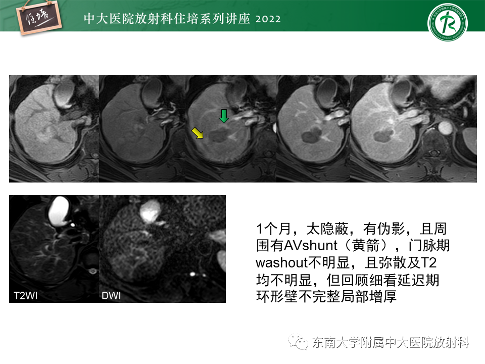 【PPT】肝癌介入治疗后的磁共振评估-25