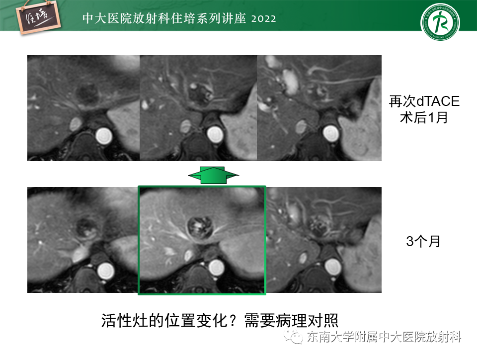 【PPT】肝癌介入治疗后的磁共振评估-23