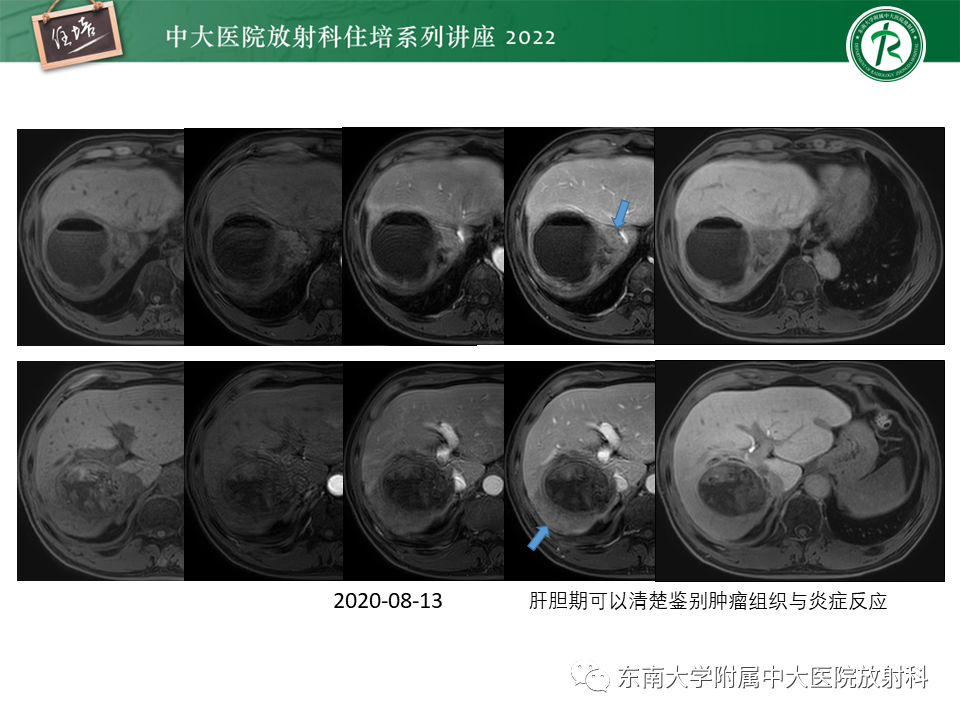 【PPT】肝癌介入治疗后的磁共振评估-41