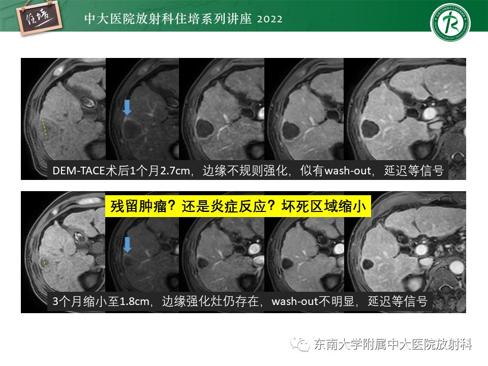 【PPT】肝癌介入治疗后的磁共振评估-19
