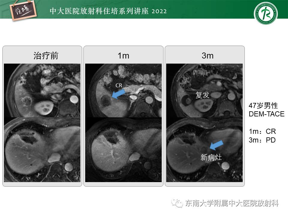 【PPT】肝癌介入治疗后的磁共振评估-30