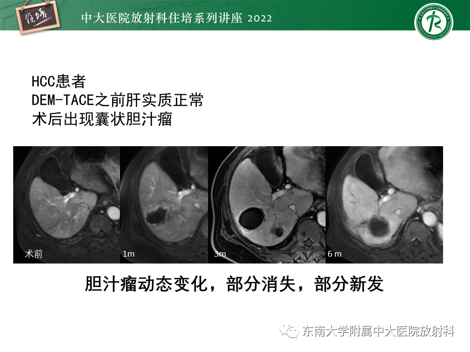 【PPT】肝癌介入治疗后的磁共振评估-46
