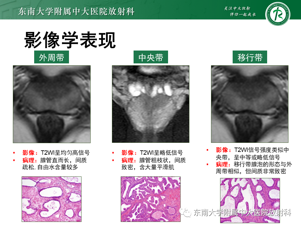 【PPT】前列腺癌-12