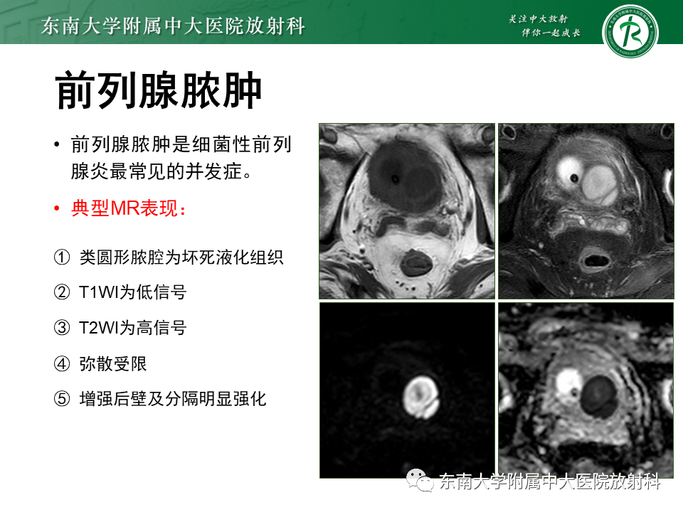 【PPT】前列腺癌-27